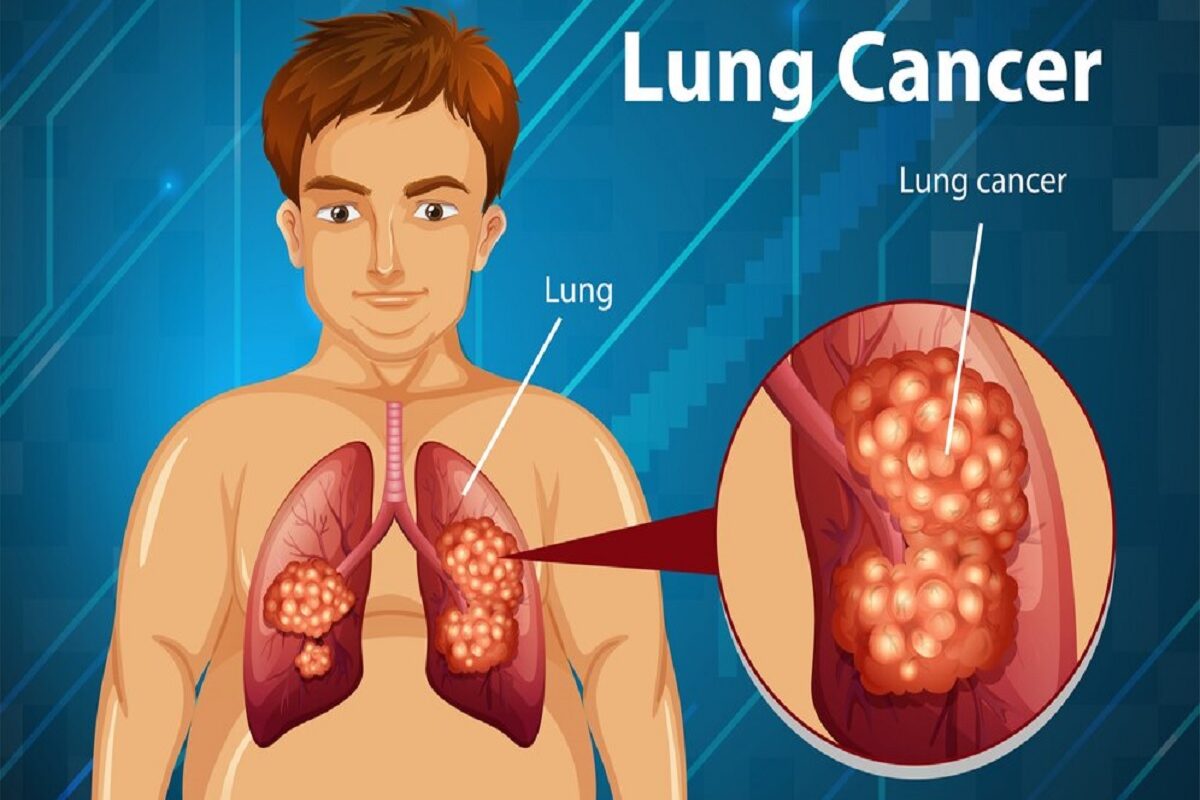 Lung-Cancer