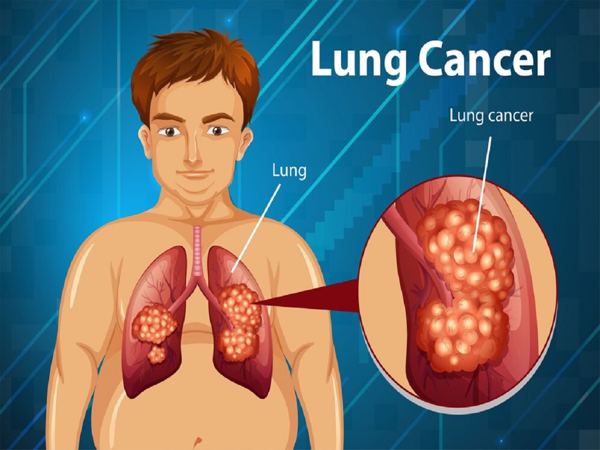 Lung-Cancer